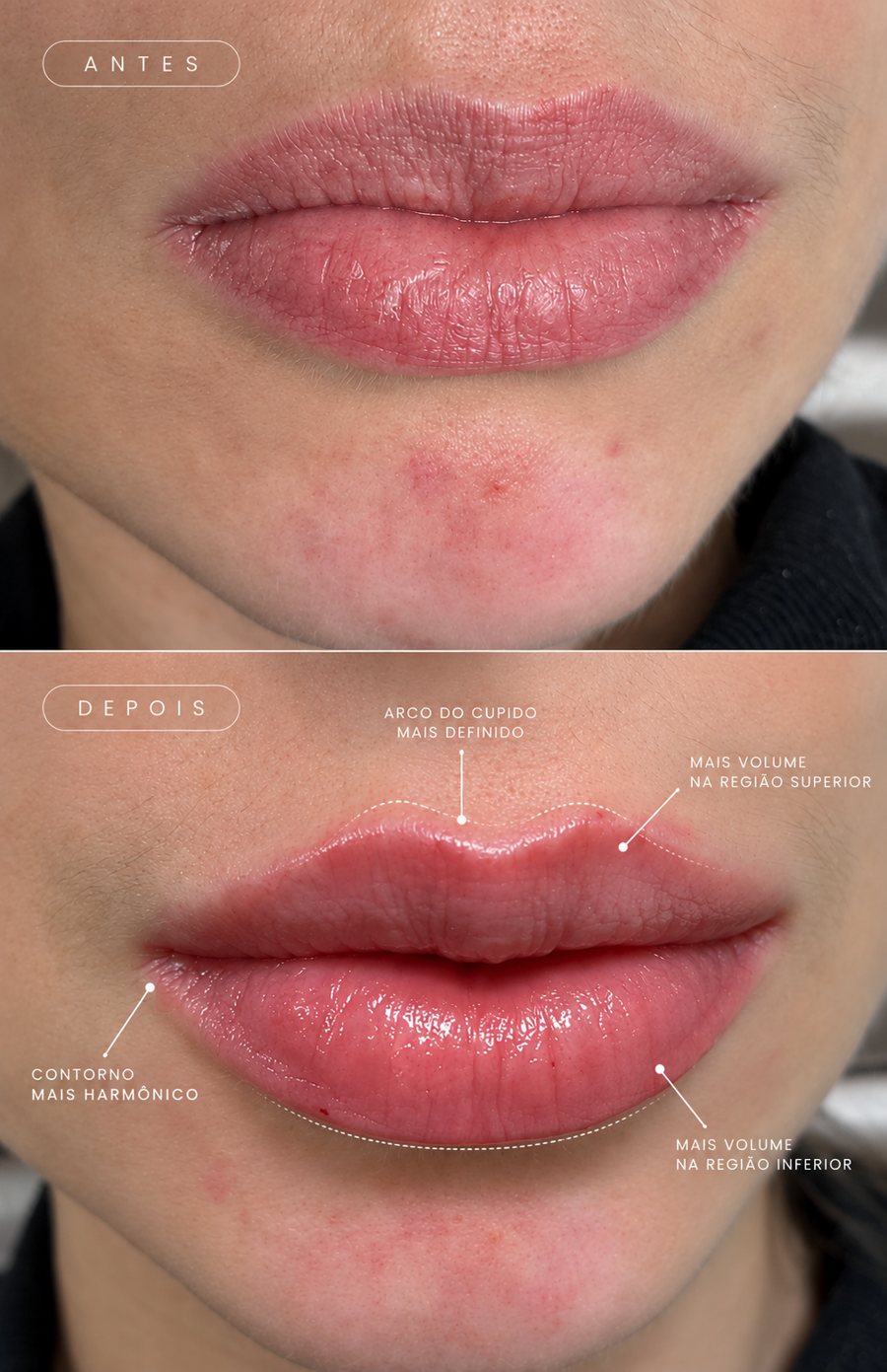 Antes e depois de preenchimento labial: arco do cupido mais definido, contorno mais harmônico e mais volume