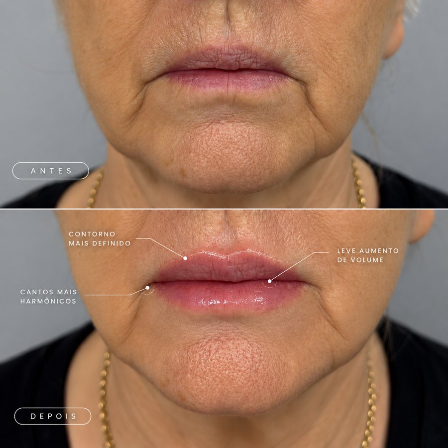 Antes e depois de preenchimento labial em paciente madura: contorno mais definido, cantos mais harmônicos e leve aumento de volume